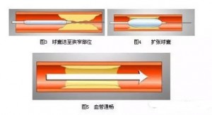 赢创尼龙12